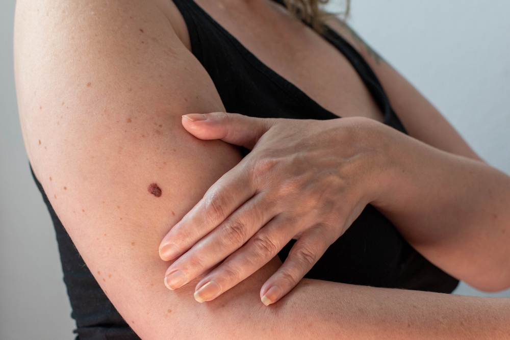 3 Signs You Need to See an Emergency Skin Cancer Doctor ASAP