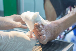 Non-healing wounds often require complex treatment. If not treated in a timely manner, there’s an increased risk of infection and even amputation.